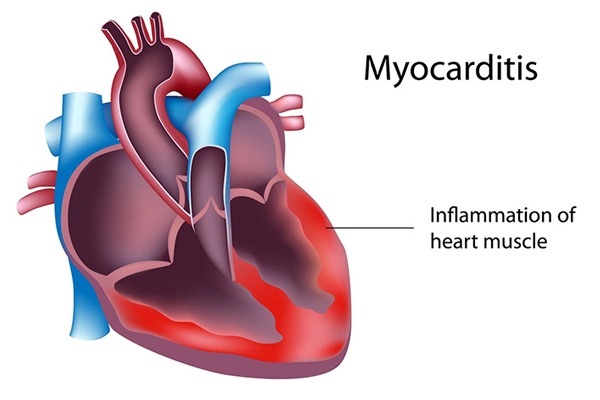 Myocarditis: What are the Symptoms, Causes and Treatment?