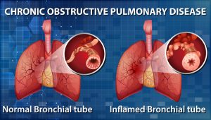 COPD