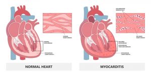 Myocarditis