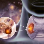 Rybelsus and Thyroid Cancer Rybelsus and Thyroid Cancer