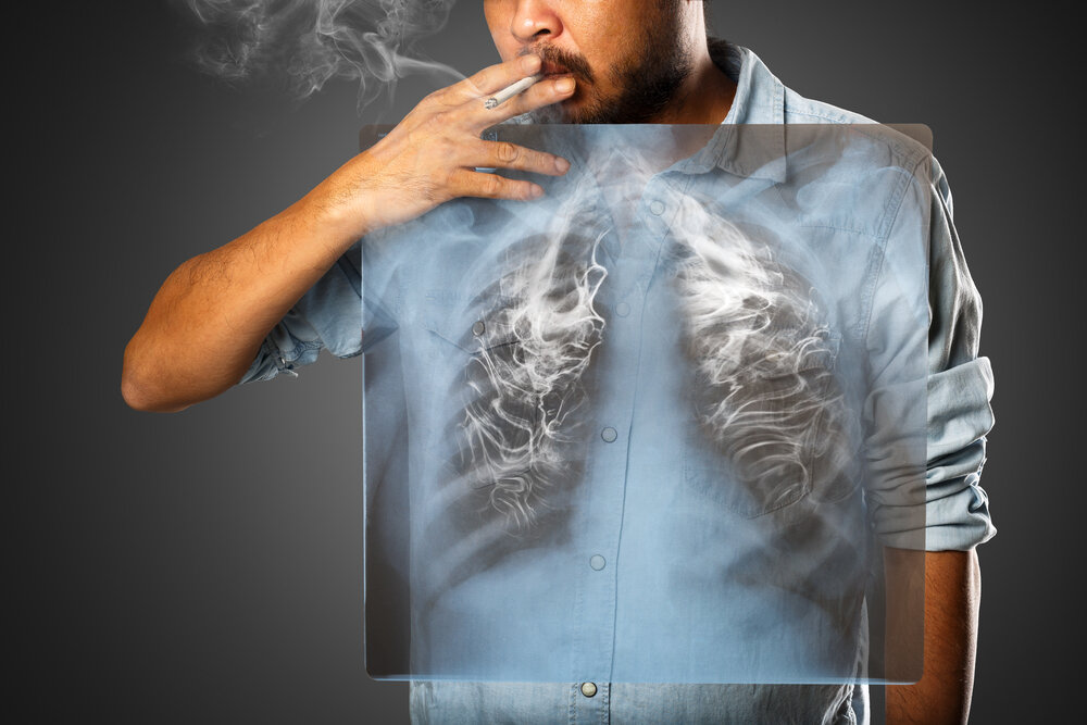 Smoking Cause Lung Cancer