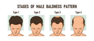 Stages Of Male Baldness Pattern