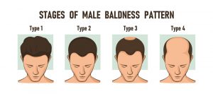 Stages Of Male Baldness Pattern Stages Of Male Baldness Pattern