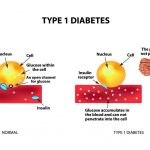 Type 1 Diabetes Type 1 Diabetes