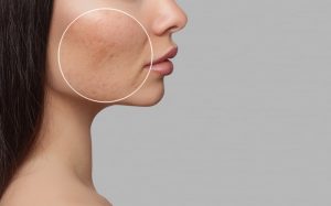 Retinol for Acne scars Retinol for Acne scars