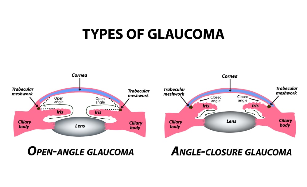 Types of Glaucoma Types of Glaucoma