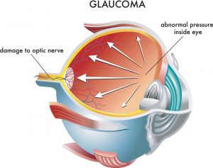 Where does Glaucoma start?