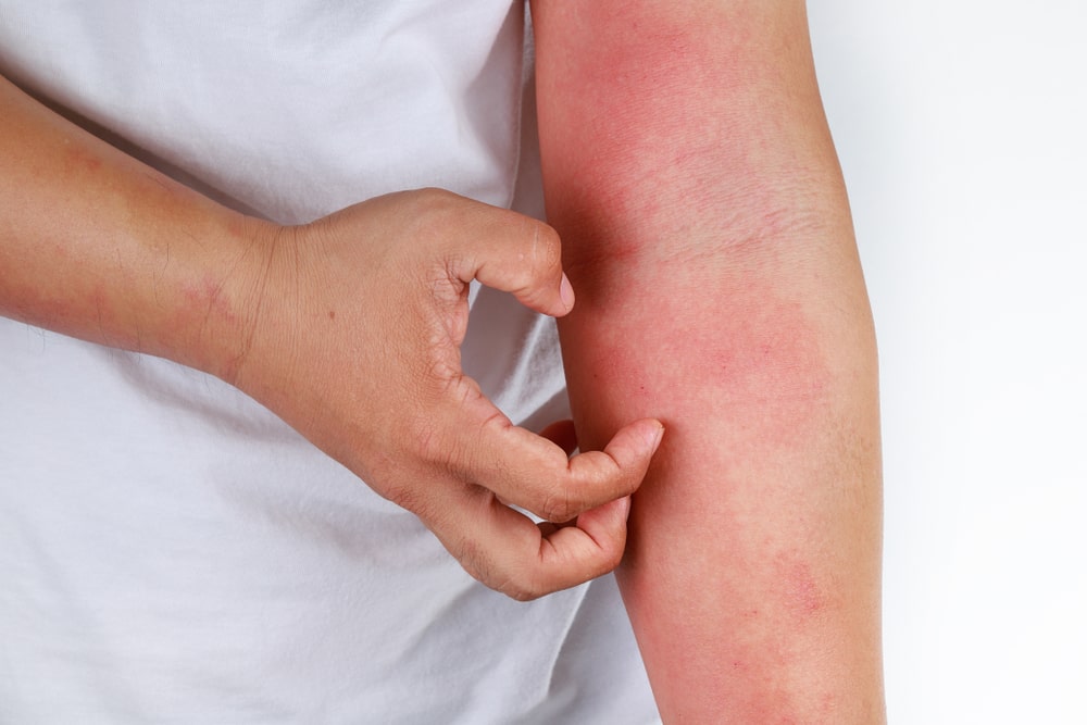 How To Stop Eczema Itching Immediately? Know More