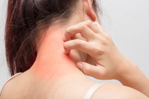 Why does eczema cause itchiness?