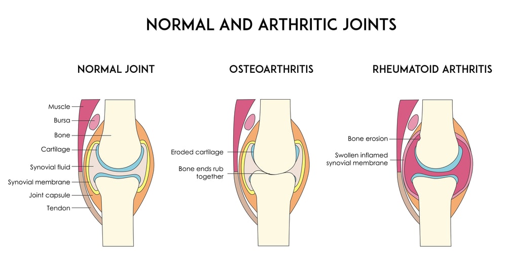 Types Of Arthritis Types Of Arthritis
