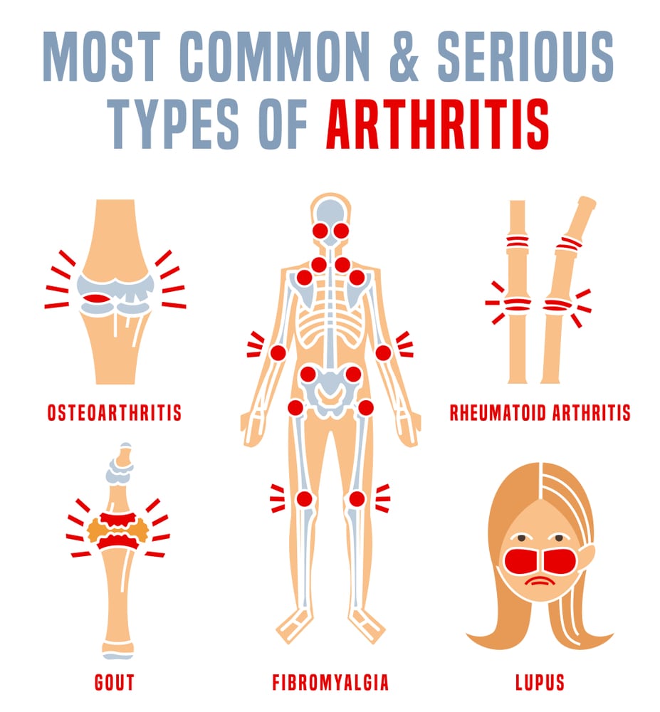 Types of Arthritis