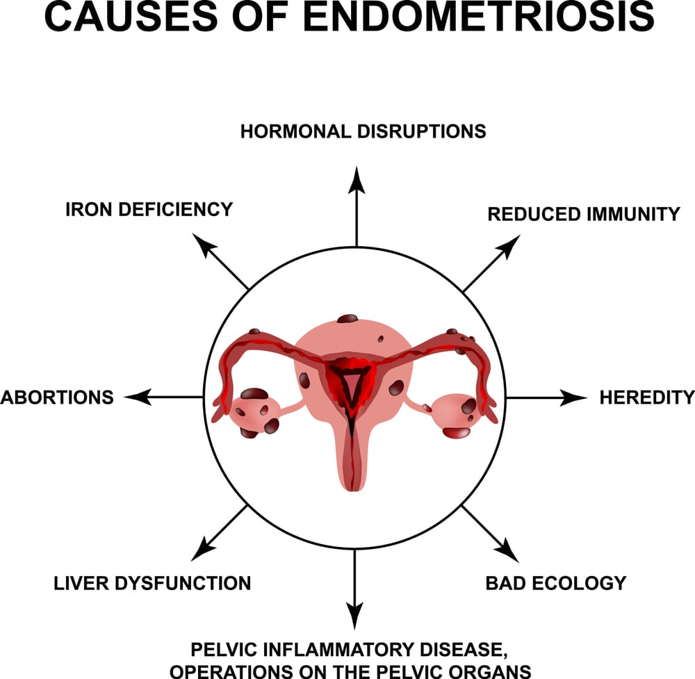 Endometriosis Causes