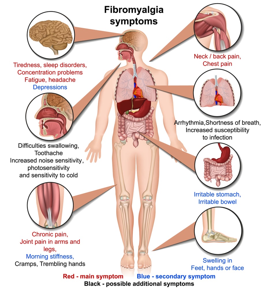 Fibromyalgia Symptoms