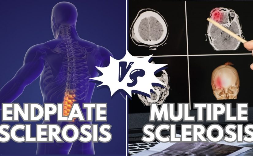 Is Endplate Sclerosis The Same As Multiple Sclerosis